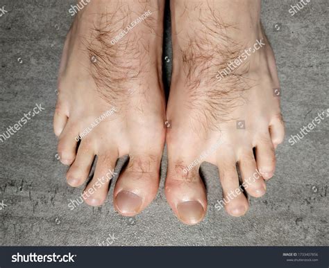'atk hairy feet toes' Search .